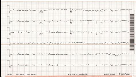 EKG Demonstrating Sinus Tachycardia With Low Voltage QRS And Few