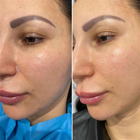 Dermatology, cosmetic & laser surgery for nyc, manhattan & worldwide. Eye Brow Lift and Cat Eye, Fox Eye Lift | Dr Deniz Kanliada