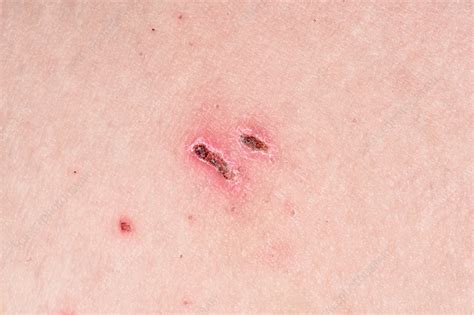 Pityriasis Lichenoides Chronica Stock Image C0381585 Science