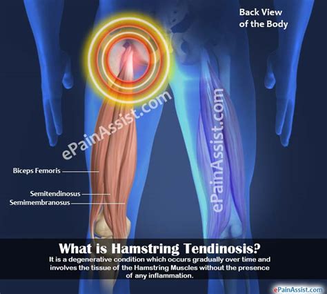 What Causes A Pulled Hamstring Hamstring Injury Nhs