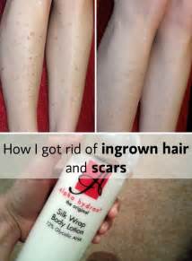 A course of treatments is usually needed at four week intervals to catch the hairs at the right. Pin on health