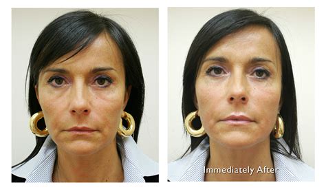 Ultraformer Painless Non Surgical Face Lift Juverne