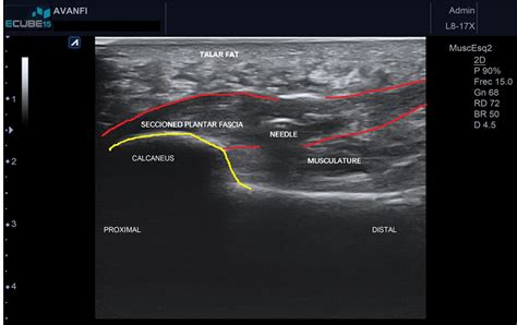 Ultrasound Guided Plantar Fascia Release With Needle A Novel Surgical