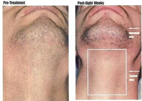 Permanent Hair Removal For Men Hair Removal