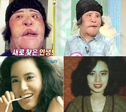 Model Who Injected Cooking Oil Into Face Lipstick Alley