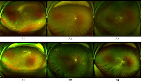 Ultra Widefield Fundus Images Showing Typical Misclassified Cases In