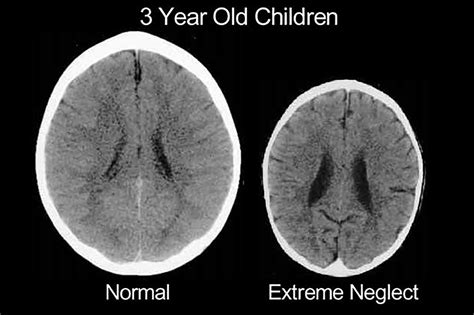 Brain Scans Reveal How Badly Emotional Abuse Damages Kids
