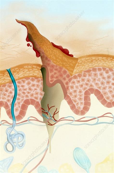 Artwork Of A Cross Section Of A Cut In The Skin Stock Image M330