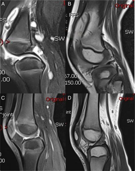 Mris Of The Left Knee Sagittal Spin Echo T1 Weighted Trte 380066