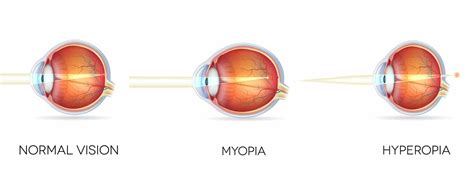 Farsightedness Hyperopia Meaning Causes Diagnosis Treatment
