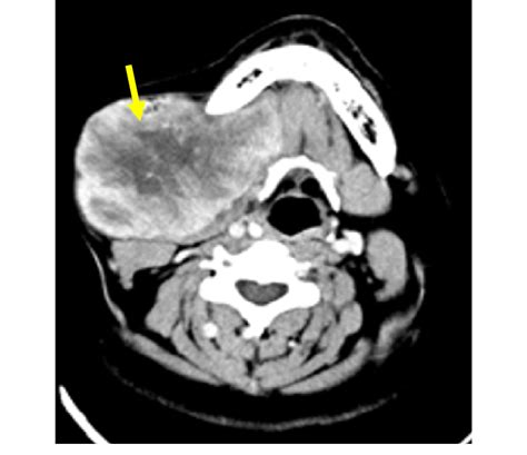 1st Ctscan Neck Of Axial View Showing A Large Right Submandibular