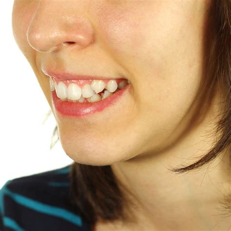 Crooked Teeth Treatment Donvale Gs Dental