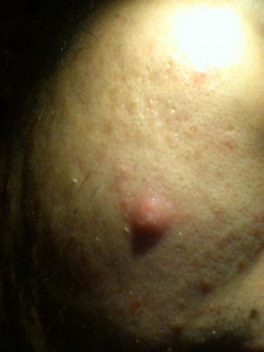 Help Is This A Nodule Or A Cyst On My Right Cheek Sad And Depressed
