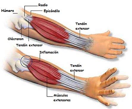 The muscles of the anterior of the forearm are generally divided into two groups:superficial deepsuperficial muscles of the front of the forearm this group consists of five muscles. Codo de tenista - Fisioteca