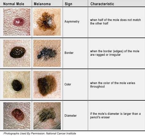 Difference Between Normal Mole And Melanoma Medizzy