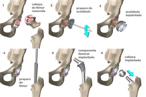 Prótese De Quadril Artroplastia De Quadril Instituto Trata