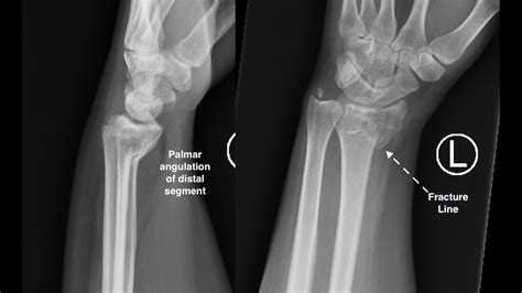Wrist X Ray Interpretation Osce Guide Geeky Medics