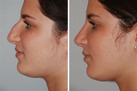 Rhinoplasty Nose Surgery Nose Job For Women In New York City David Rosenberg M D Pllc