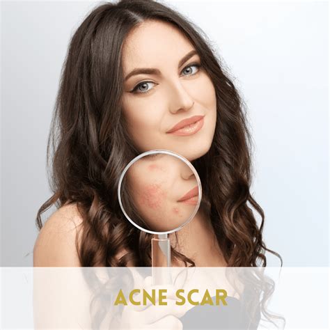 Acne Scar Advanced Aesthetic Specialist