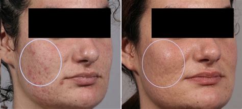 Mothlhtqqjbpqdp Micro Needling Scar Before And After