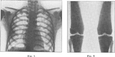 Figure 1 From Malunion Of Tibia And Fibula Semantic Scholar