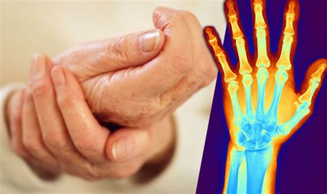 Joint Exercises For Arthritis In Fingers Online Degrees