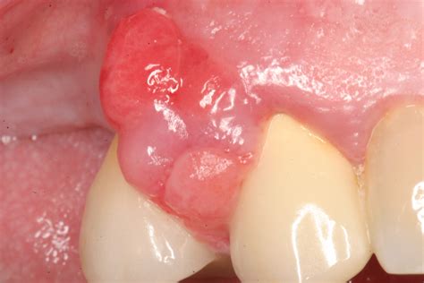 The Importance Of Periodontal Treatment In Postcovid 19 Dentistry