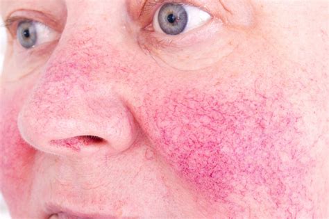 Identifying Common Red Spots On Skin Universal Dermatology