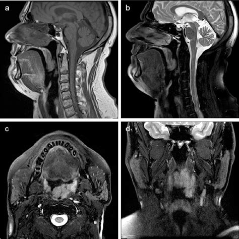 Oropharyngeal Cancer Imaging Anatomy And Pathways Of Spread In Staging