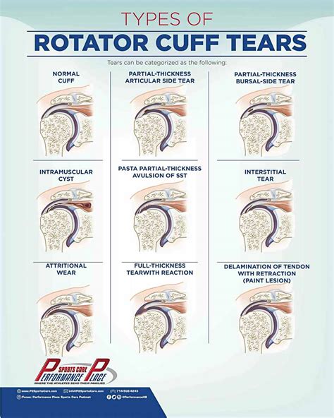 Diagram Diagram Of Rotator Cuff Tear Mydiagram Online