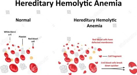 The Many Types Of Hemolytic Anemia You Must Know About Trionds