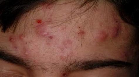 Acne Scars Types And Overview