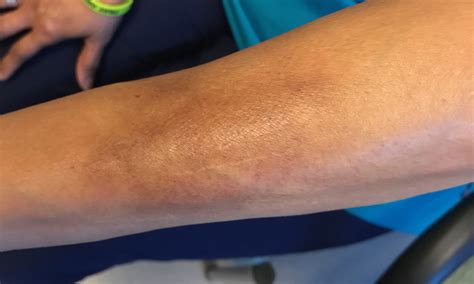 Hyperpigmented Lesions On Arms Clinical Advisor