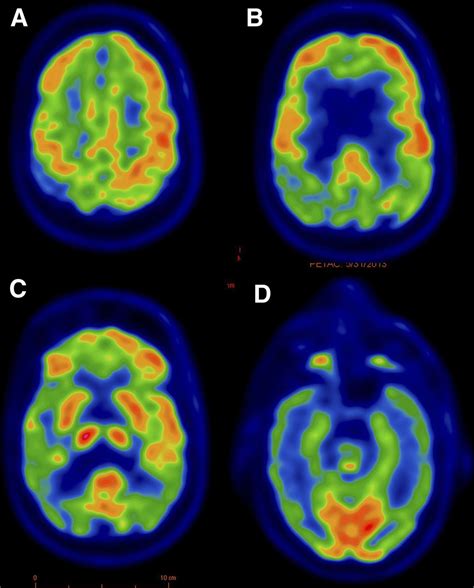 Complementary Role Of 18f Fdg Pet And 123i Ioflupane Spect In The