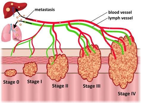 Colorectal Cancer Overpath