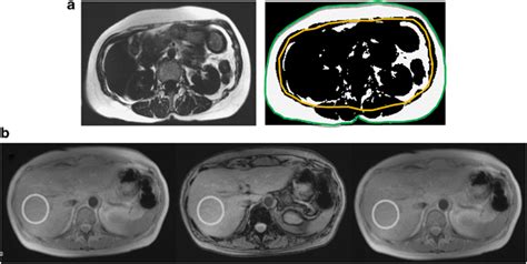 Abdominal Fat Distribution Assessed By Magnetic Resonance Imaging A