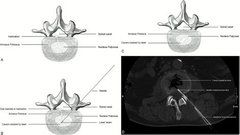 Percutaneous Laser Disk Decompression A Review Of The Literature