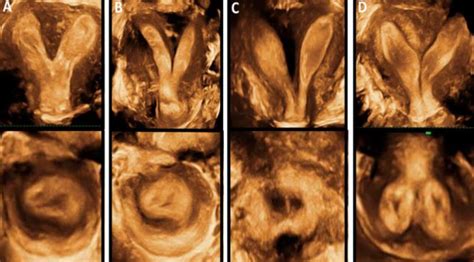 Figure From Role Of Three Dimensional Ultrasound In Uterine Anomalies D Assessment Of
