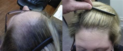 The Hair Loss Centre Female Hair Loss Photos Before After