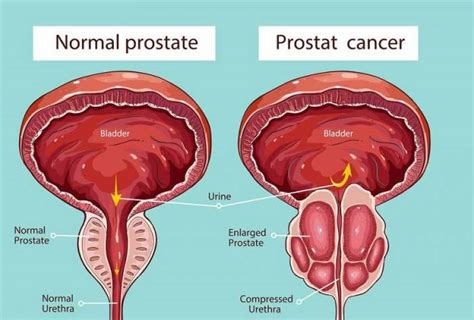 Rak prostate dijagnoza i lečenje