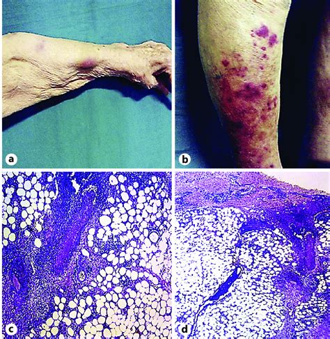 Panniculitis With Vasculitis A Subcutaneous Nodules On The Upper Arm