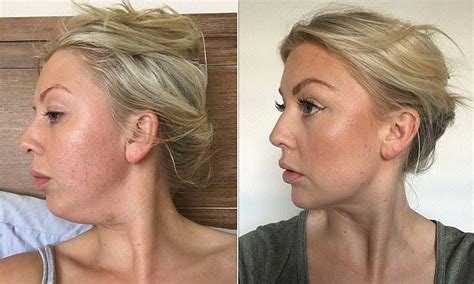 How one woman finally got rid of her double chin WITHOUT liposuction