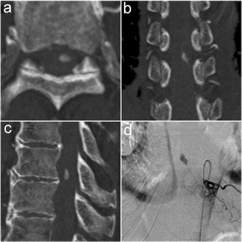 Spinal Intraarterial Ct Angiography A C And Spinal Angiography D