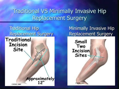 Ppt Minimally Invasive Hip Surgery Powerpoint Presentation Id