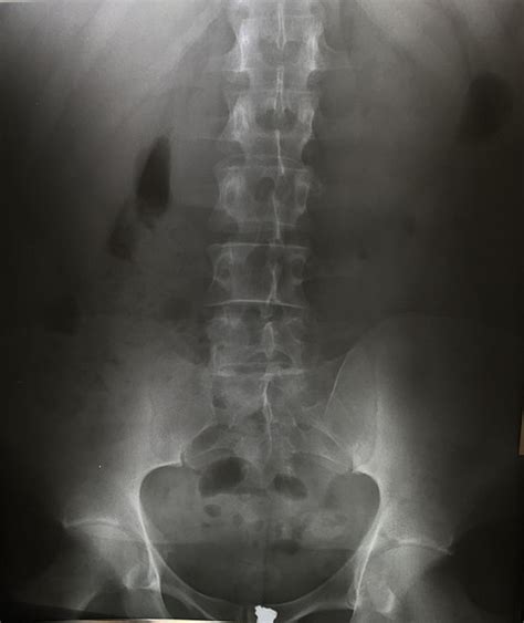 Lumbar Vertebrae Anatomy Xray