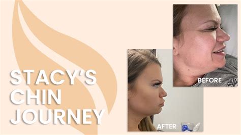 Sono Bello Laser Liposuction Ditch Your Chin Fat In 1 Day Youtube