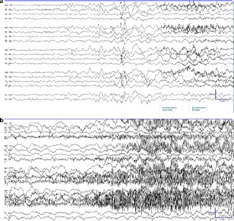 A Seizure With Dyscognitive Feature Followed By Generalized