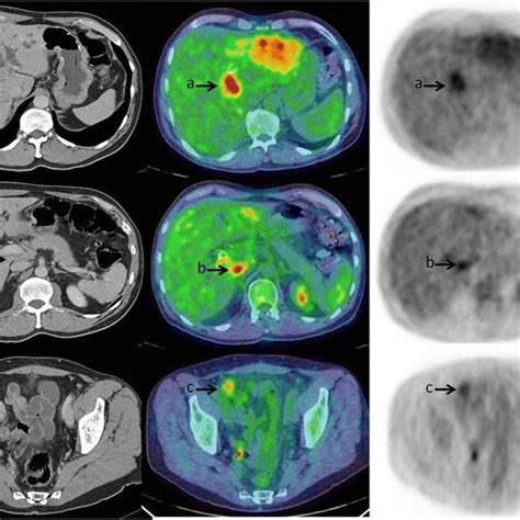 Axial Image Panels Of Contrast Enhanced Ct Fused Pet Ct And Pet In A