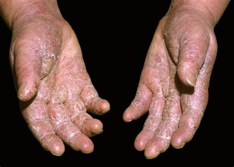 Patient Reported Psoriasis Diary Effectively Identifies Clinical
