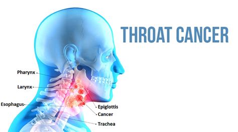 Cancer Of The Throat Images
